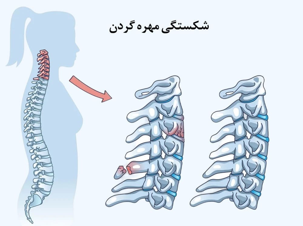 شکستگی مهره گردن و درمان آن
