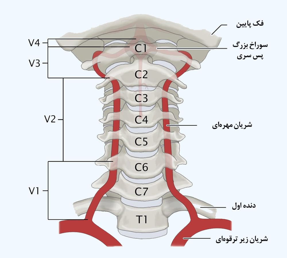 ارتباط محل شکستگی مهره گردن و نوع درمان