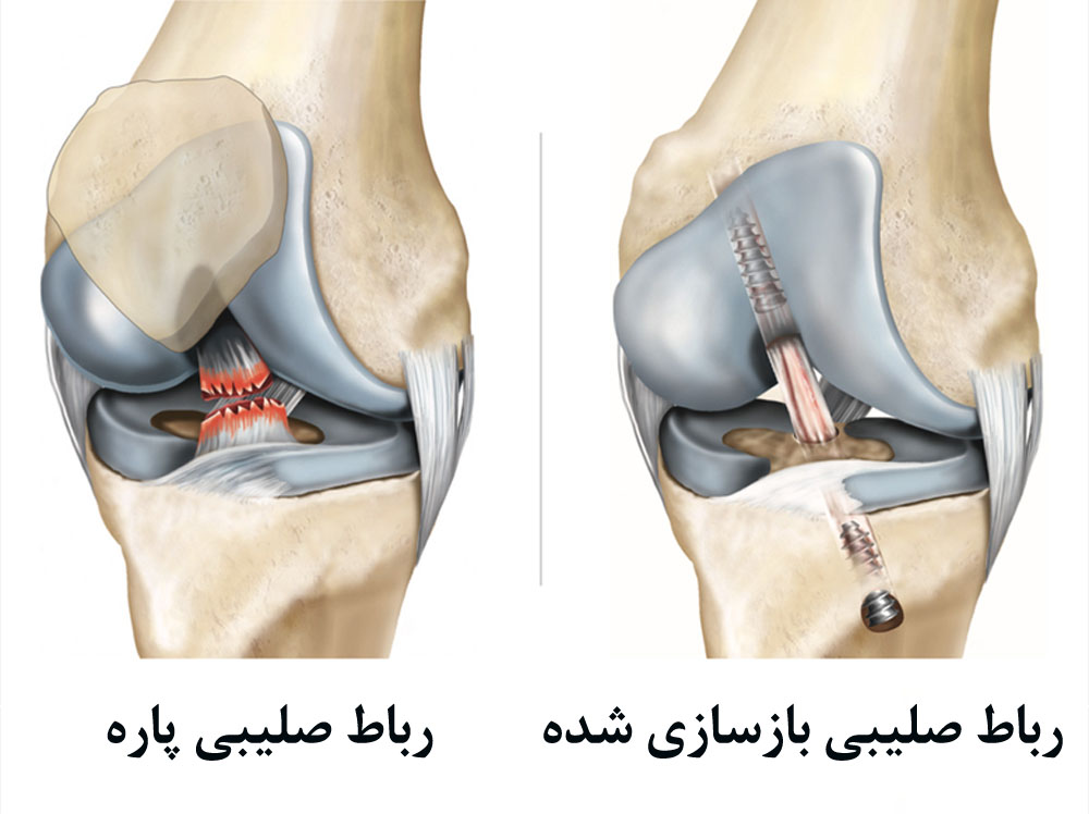 رباط صلیبی پاره و بازسازیشده