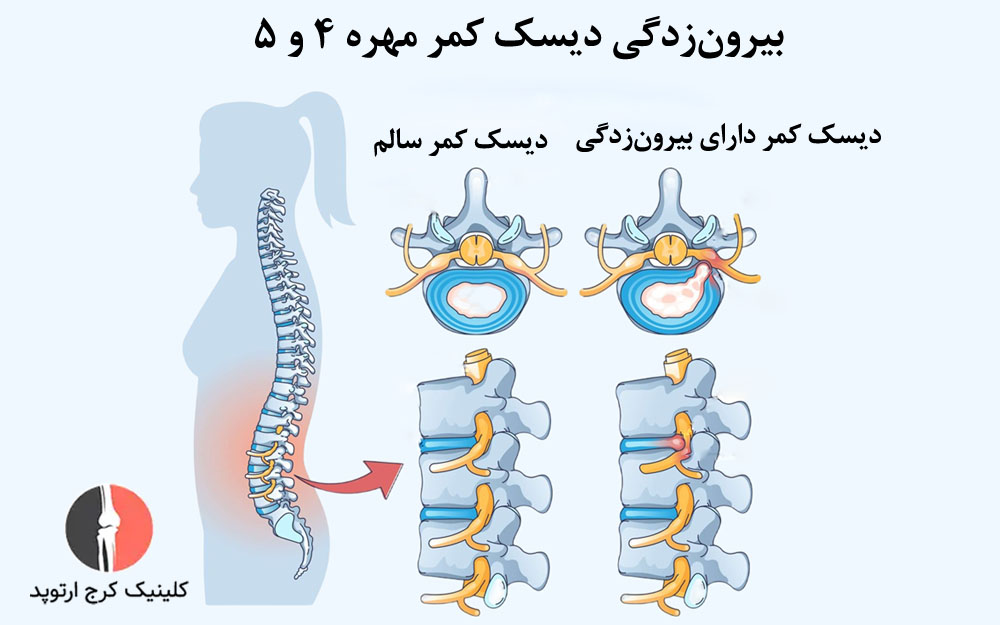 دلایل دیسک کمر مهره 4 و 5