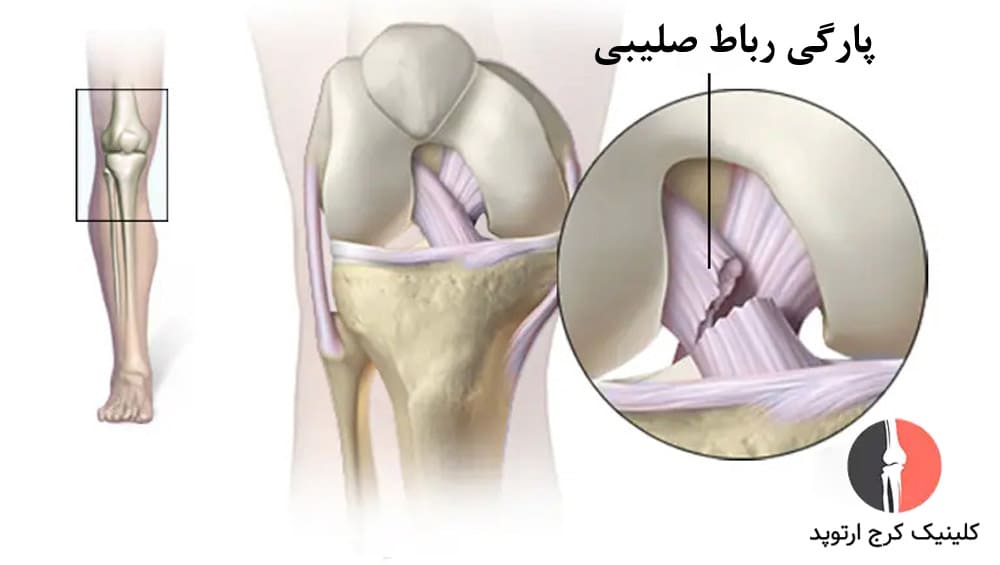 پارگی رباط صلیبی یکی از آسیبهای شایع و جدی زانو