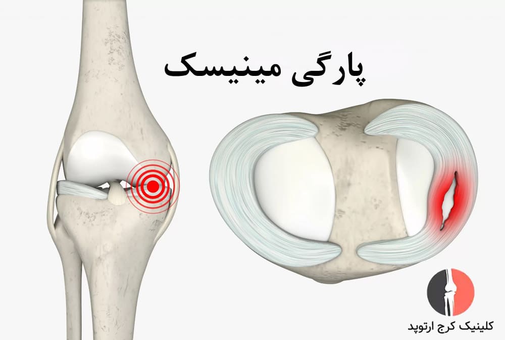 منیسک، غضروفی نرم بین استخوانهای زانو