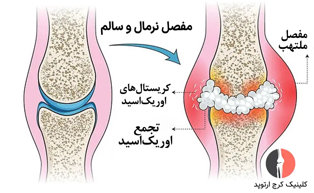 نقرس باعث درد شدید و تورم در مفاصل میشود.