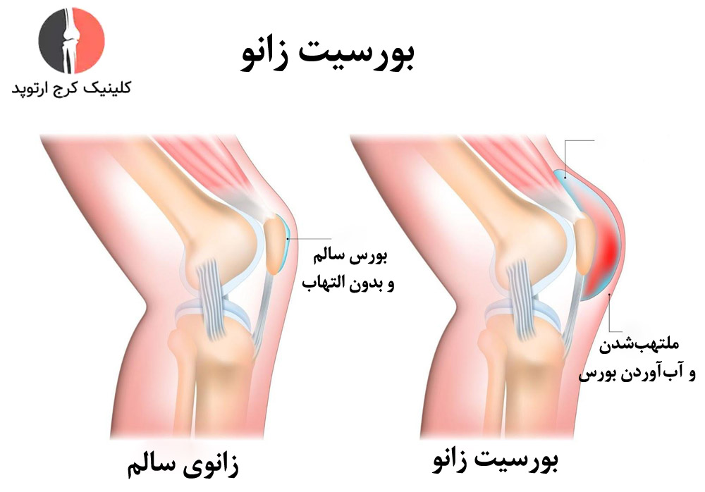 بورسیت باعث تورم و آبآوردن زانو میشود.