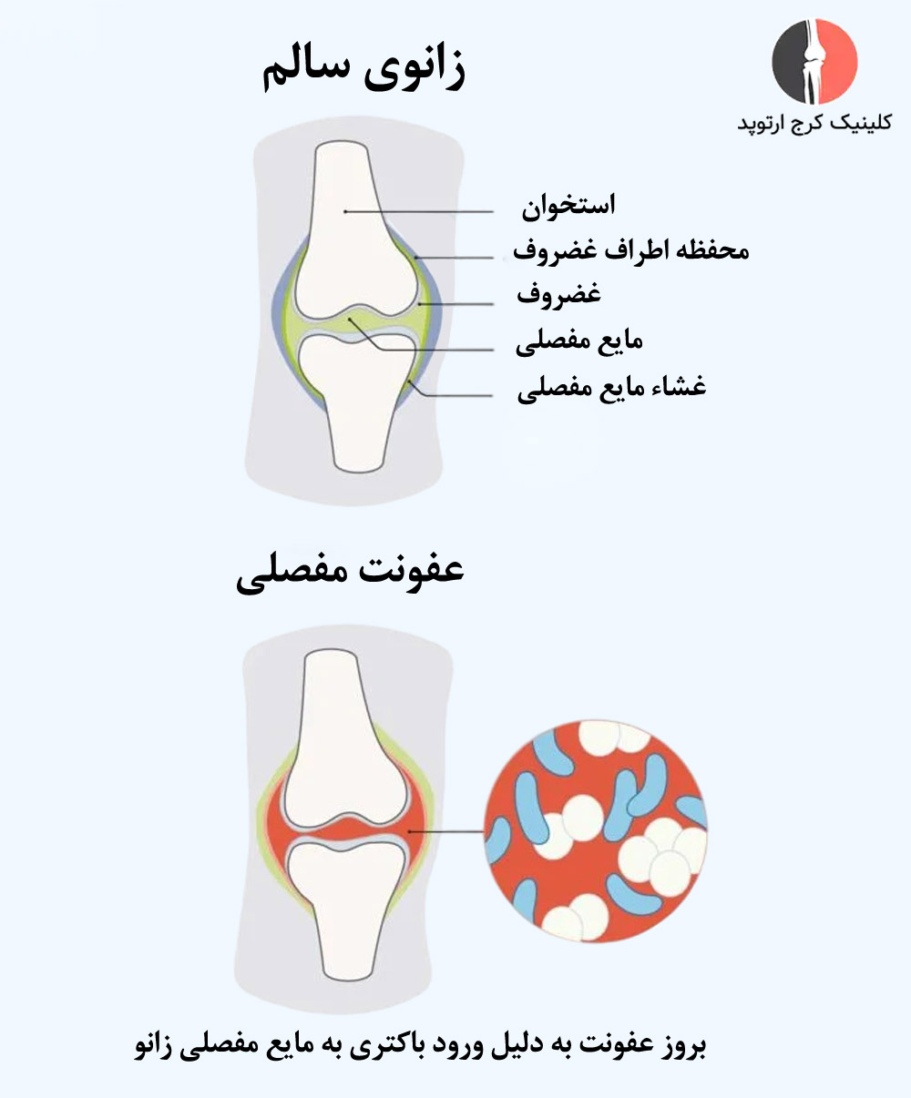 عفونتهای مفصلی باعث التهاب و تجمع مایع در زانو میشوند.