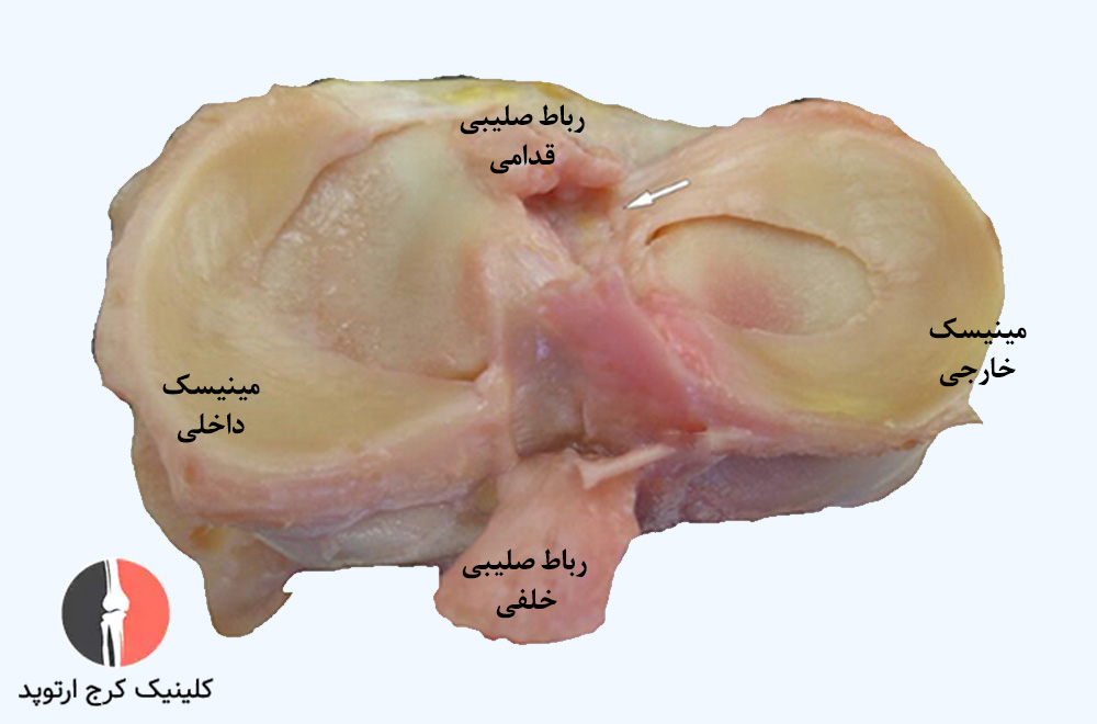 تصویر مینیسک زانو