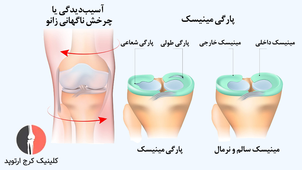 پارگی مینیسک