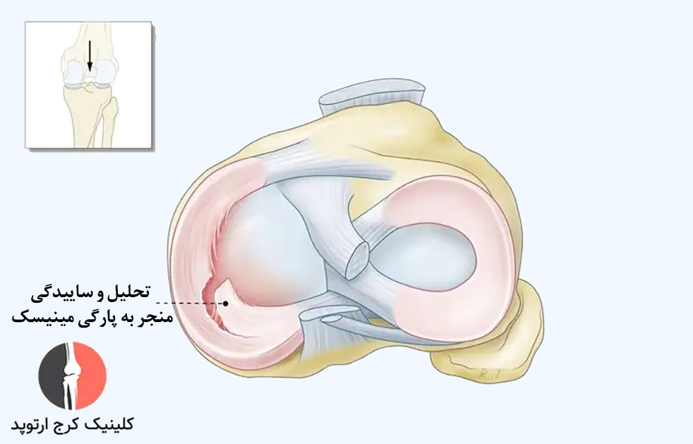 ساییدگی مینیسک زانو