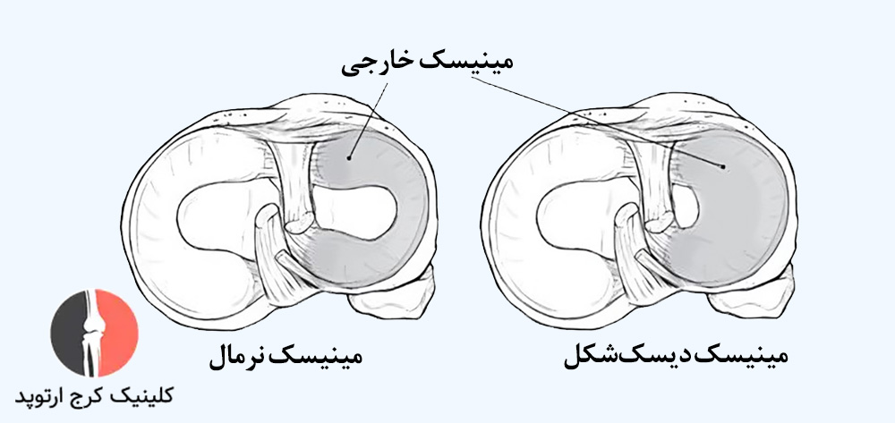 مینیسک دیسکشکل