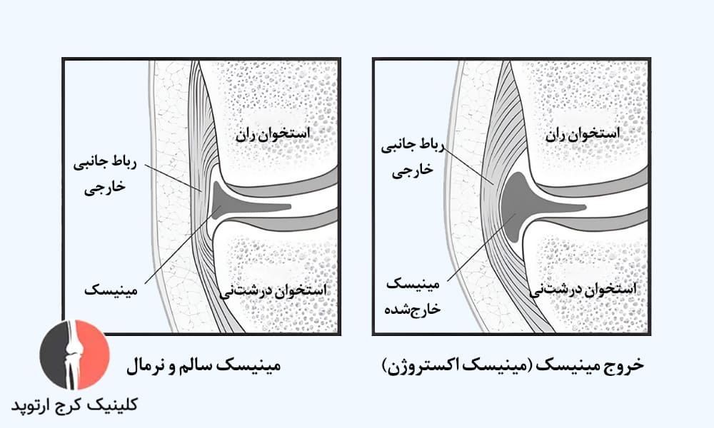 خروج مینیسک