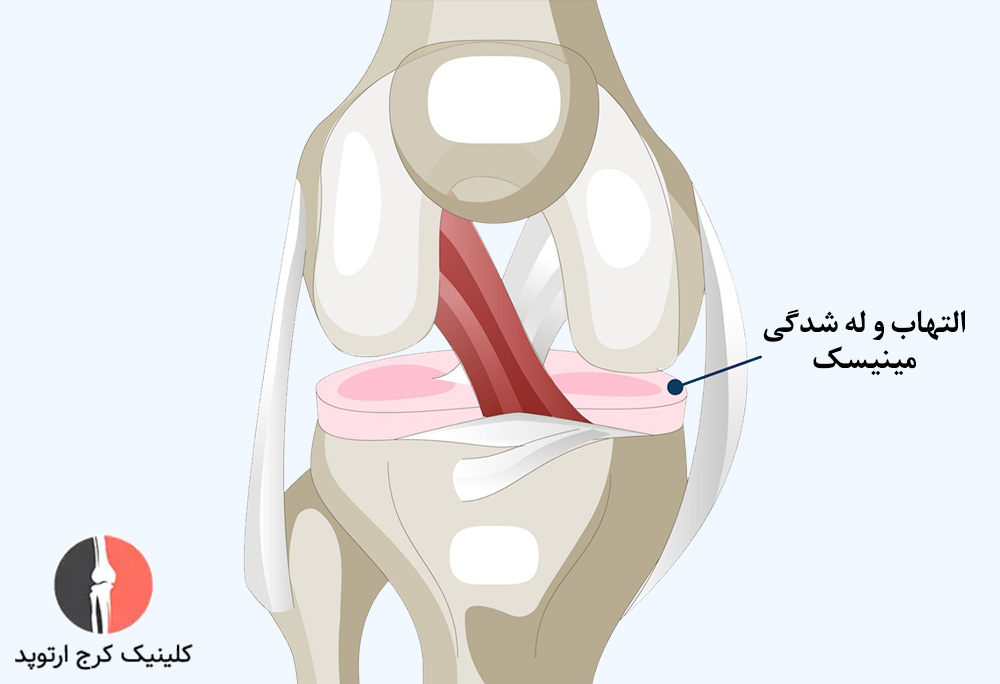التهاب و لهشدگی مینیسک