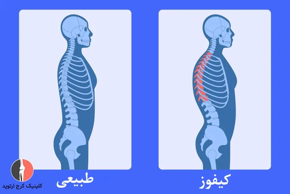 کیفوز انحنای بیش از حد ستون فقرات به سمت بیرون می باشد.