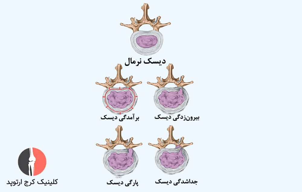 میزان بهبودی دیسکهای آسیبدیده به عواملی مانند شدت و نوع آسیب بستگی دارد.
