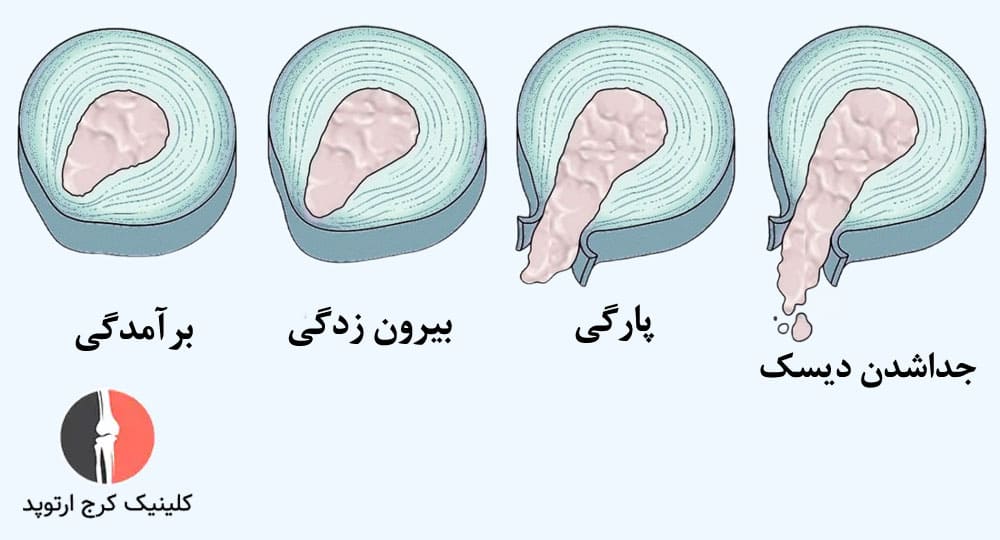 مراحل پیشرفت دیسک گردن ۴ مورد است.
