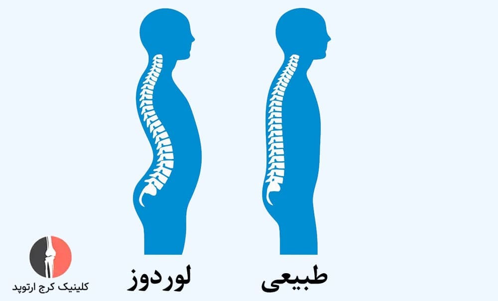 لوردوز انحنای بیش از حد ستون فقرات به سمت داخل می باشد.