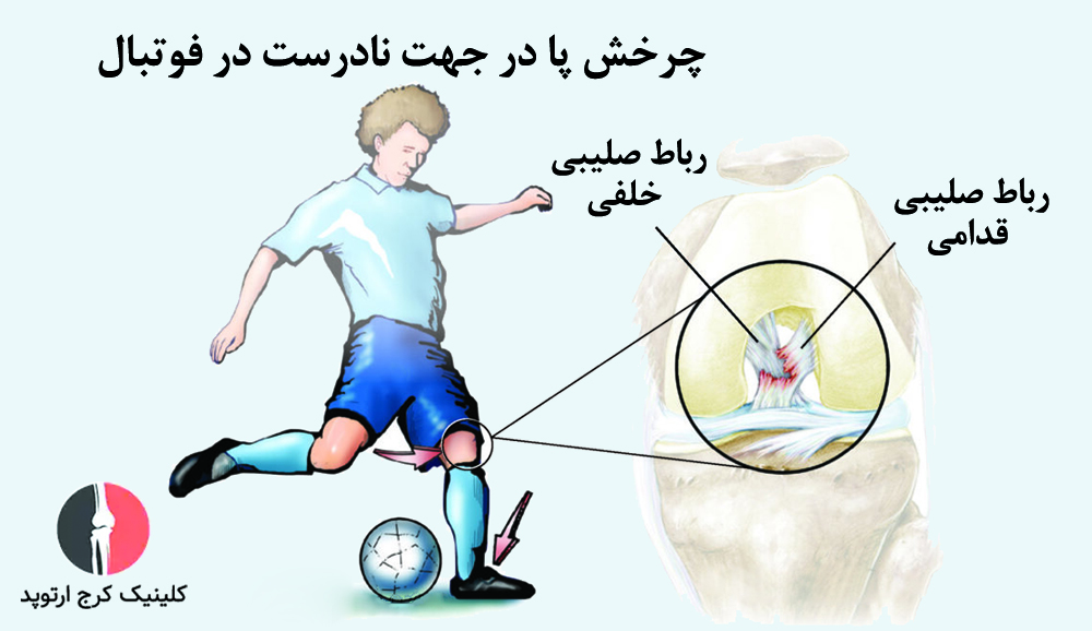 پارگی رباط صلیبی قدامی
