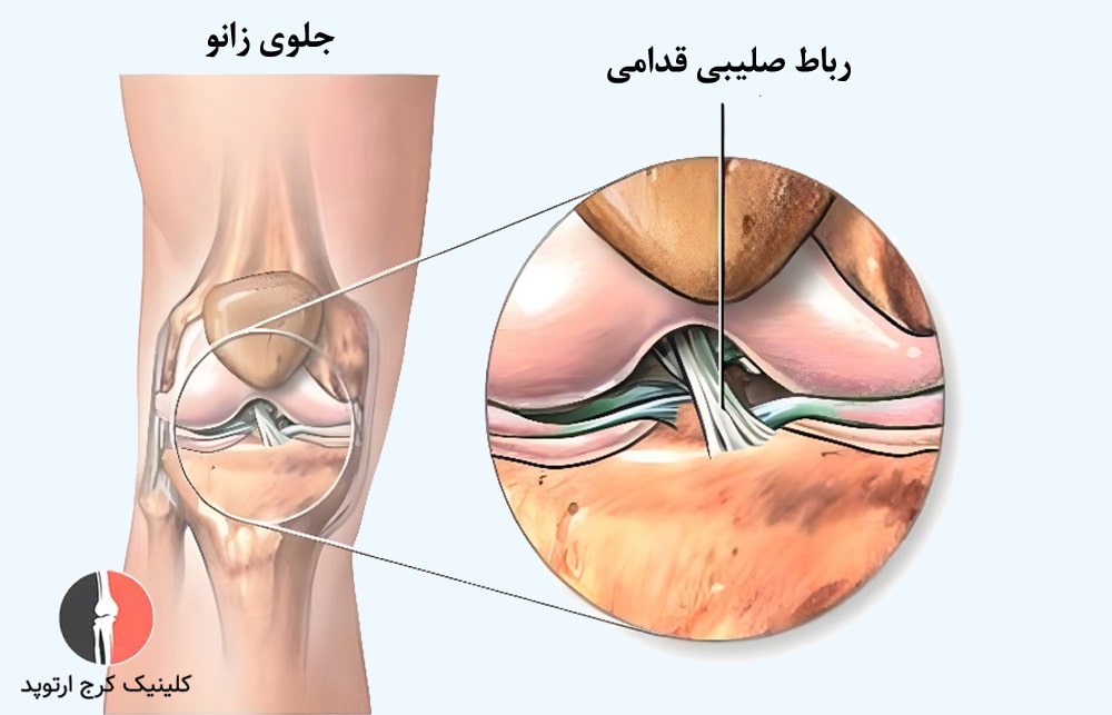 رباط صلیبی قدامی
