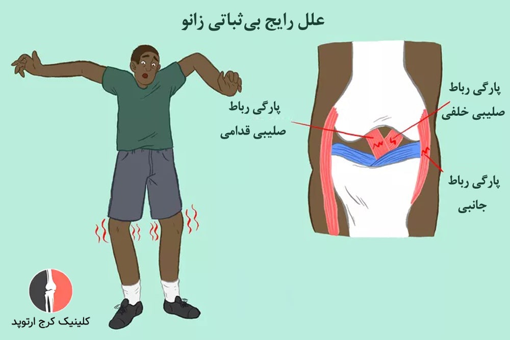 پارگی رباط صلیبی قدامی