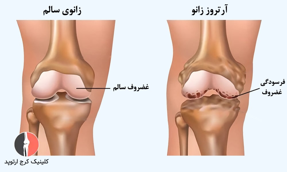 آرتروز