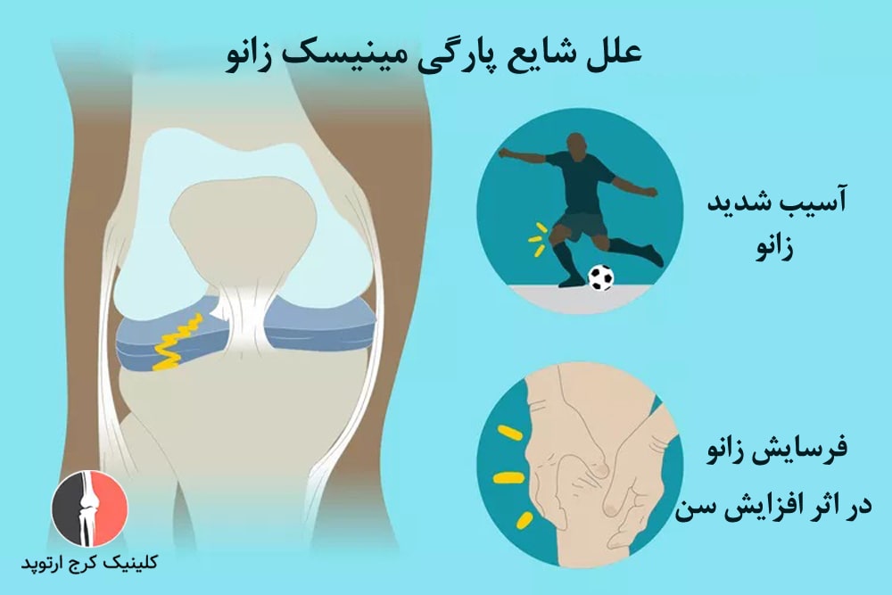 علل شایع پارگی مینیسک زانو
