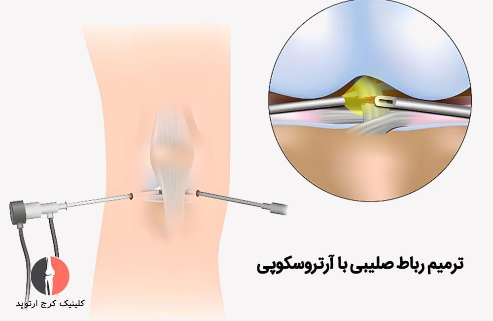 ترمیم رباط صلیبی با آرتروسکوپی