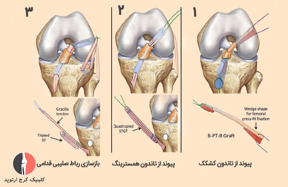 جراحی بازسازی رباط صلیبی