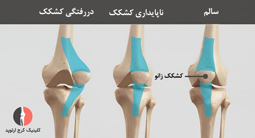 ناپایداری کشکک زانو